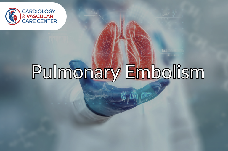 Introduction to Pulmonary Embolism (PE)