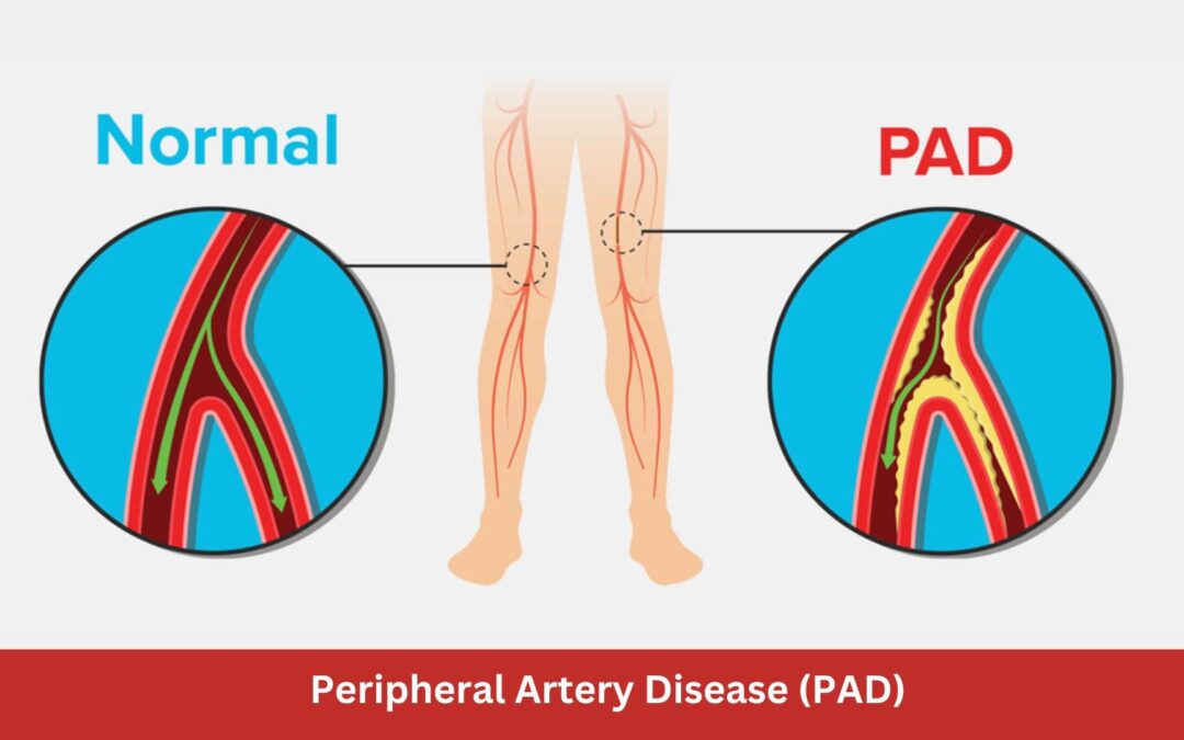 Peripheral Artery Disease (PAD)