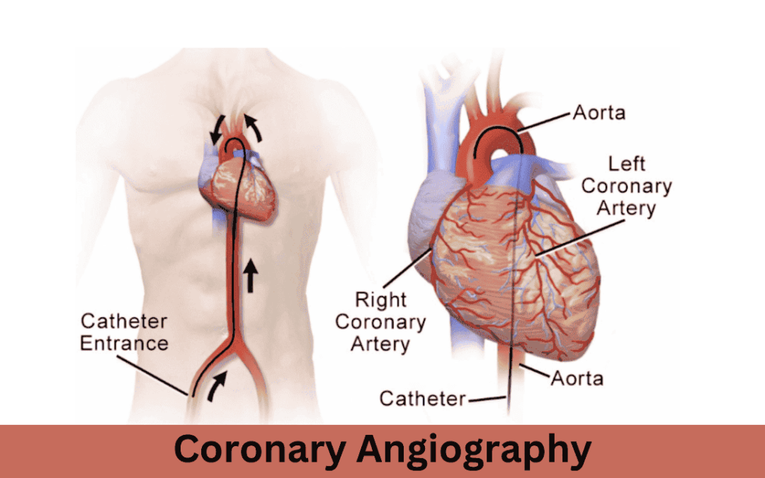Coronary Angiography