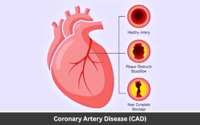 Coronary Artery Disease (CAD): Symptoms, Causes, and Treatment