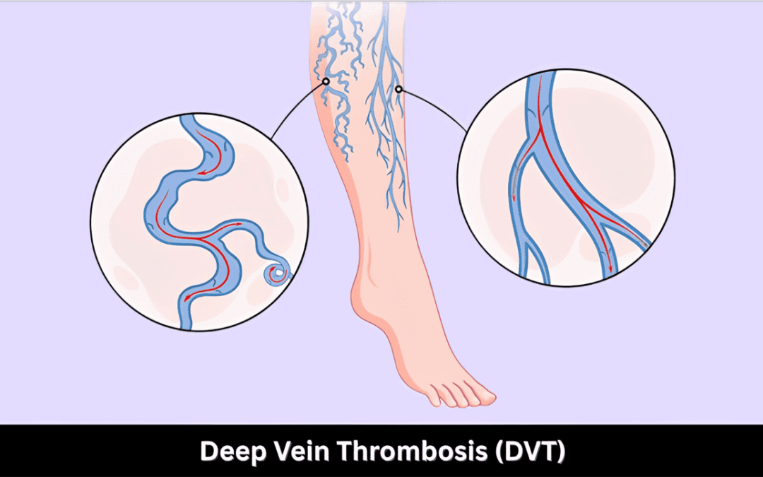 Dvt Fpnotebook Deep Vein Thrombosis (DVT): Symptoms & Causes
