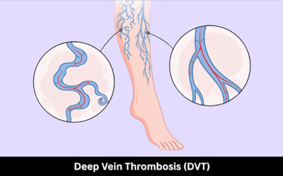 Deep Vein Thrombosis (DVT): Symptoms & Causes